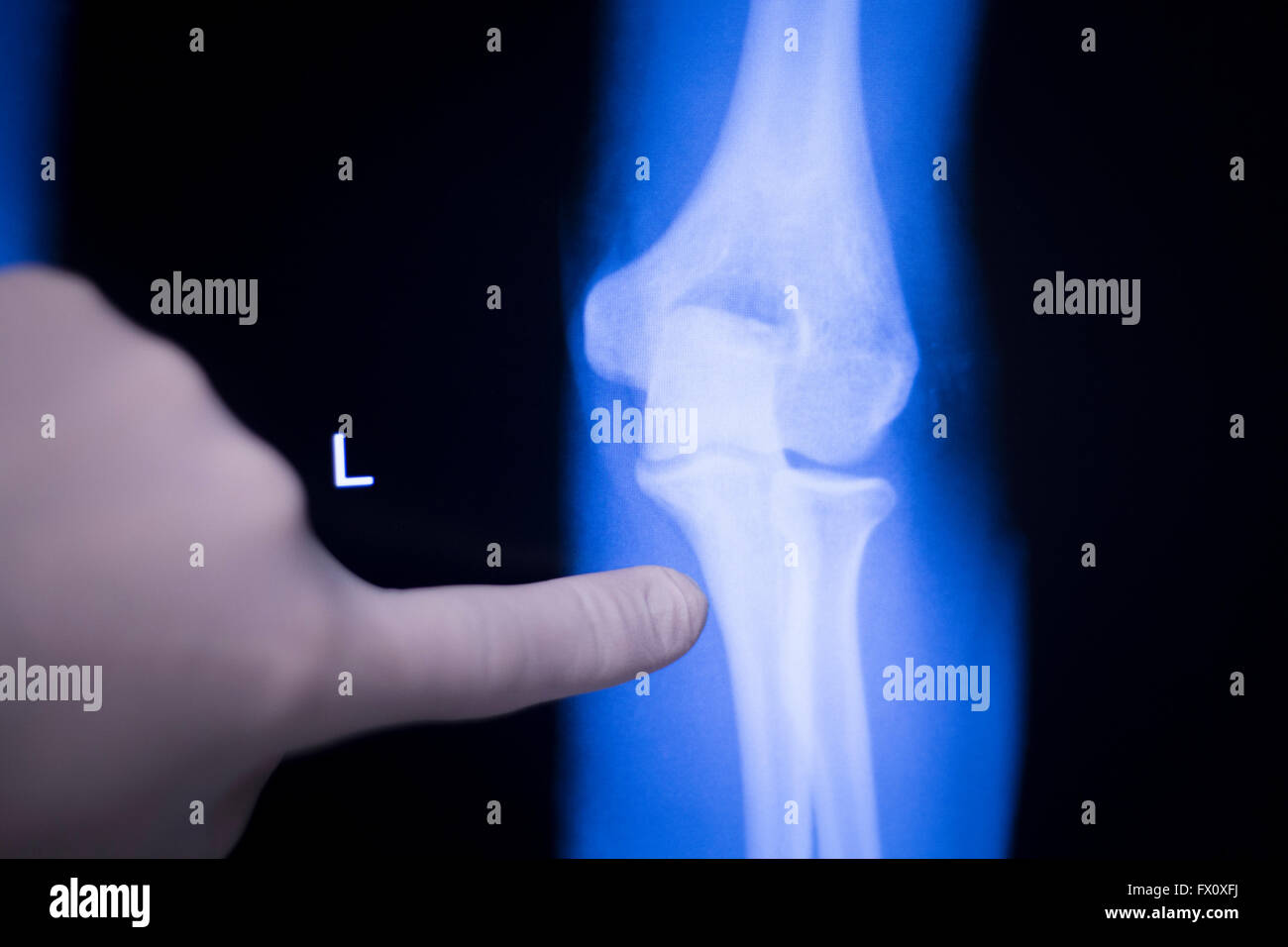 Ellenbogen, Unterarm und gemeinsame medizinische Röntgen Scan Testergebnis für senior Erwachsene Patienten mit Arthritis, Gelenkschmerzen und Mobilitätsprobleme Tennisarm verletzungsbedingt zu bewaffnen. Stockfoto