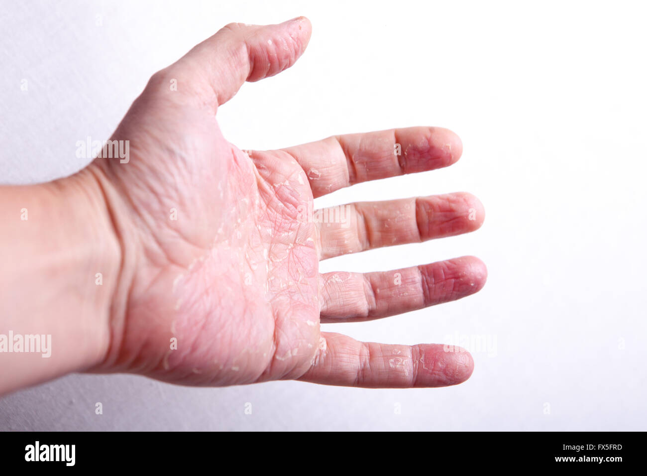 allergische Dermatitis Hautausschlag Hautbeschaffenheit des Patienten Stockfoto