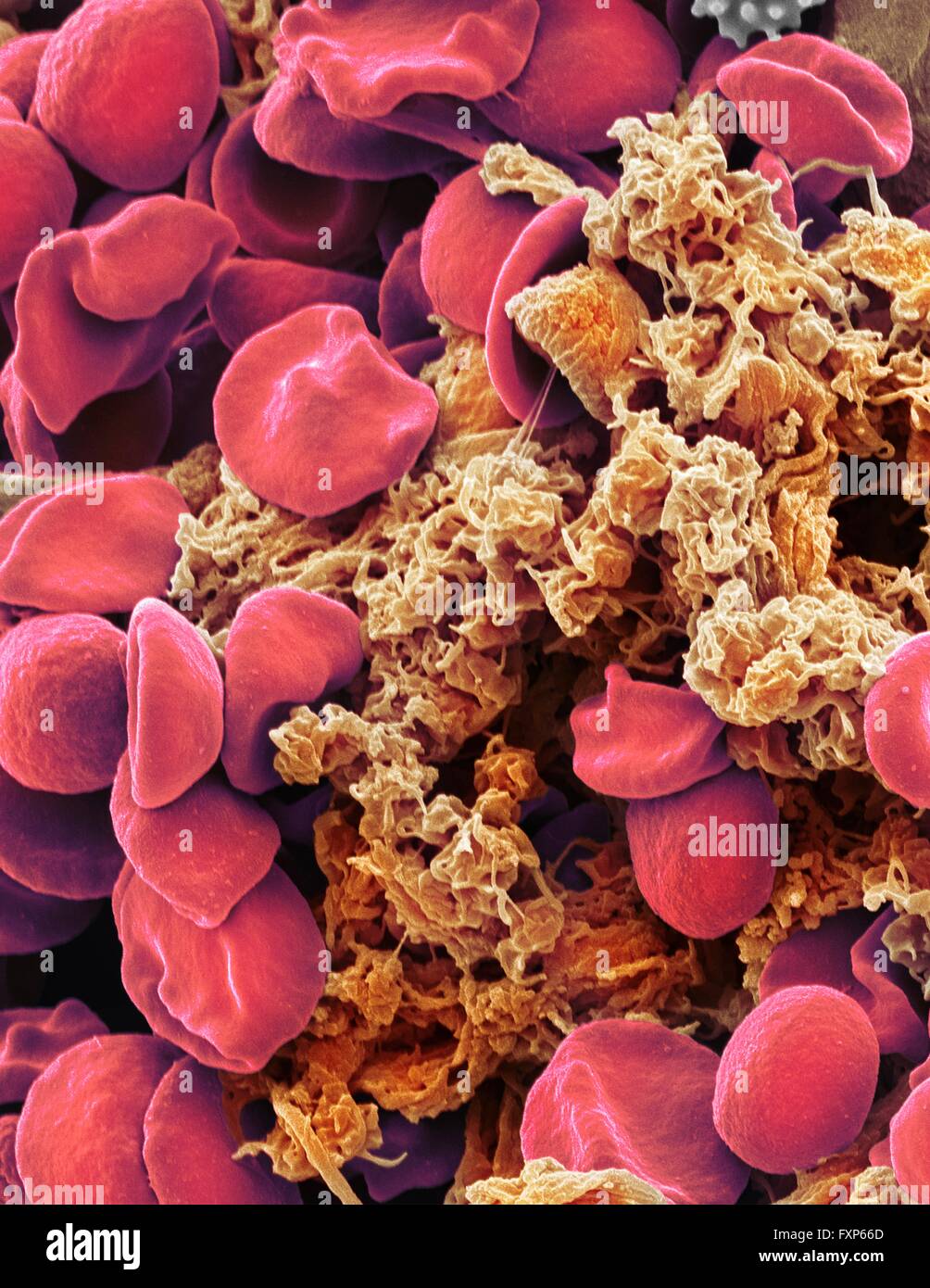 Roten Blutkörperchen und Blutplättchen. Farbige Scannen Electon Schliffbild (SEM) der menschlichen Erythrozyten (roten Blutkörperchen) und ein Plättchen-Aggregat (Orange). Thrombozyten sind Fragmente der weißen Blutkörperchen, die unter normalen Umständen klein und bikonkave Form sind. Jedoch ist eine Pause in der Oberfläche eines Blutgefäßes, die Moleküle der Thrombozyten Berührung sind nicht daran gewöhnt und werden aktiviert. Sie werden amorphe Form mit langen Fortsätzen (Pseudopodien), mit denen sie an anderen Zellen und andere, halten ein Gerinnsel bilden. Vergrößerung: X3000 wenn bei 10 Zentimeter gedruckt Stockfoto