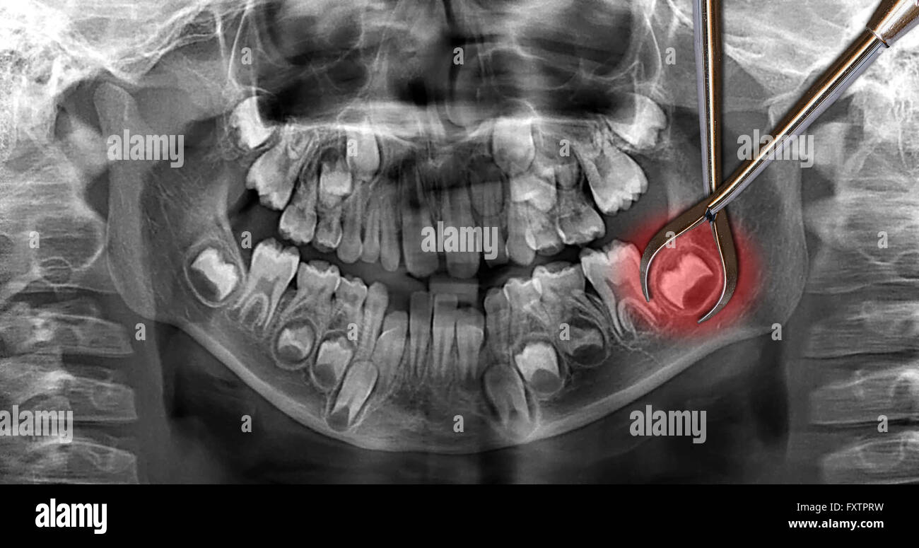 Chirurgie-Zahnextraktion zu simulieren Stockfoto