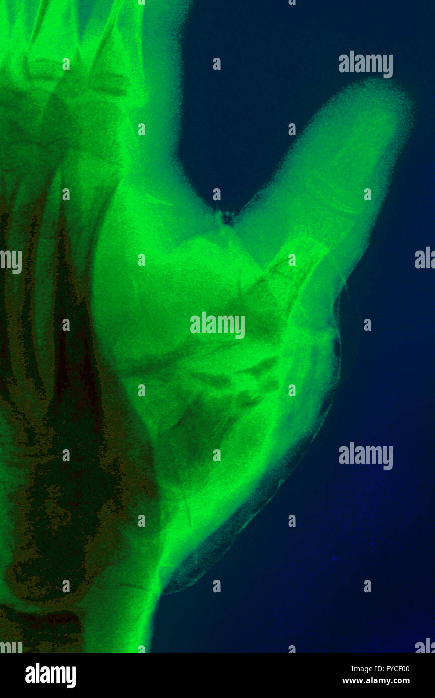 GEBROCHENEN FINGER, X-RAY Stockfoto