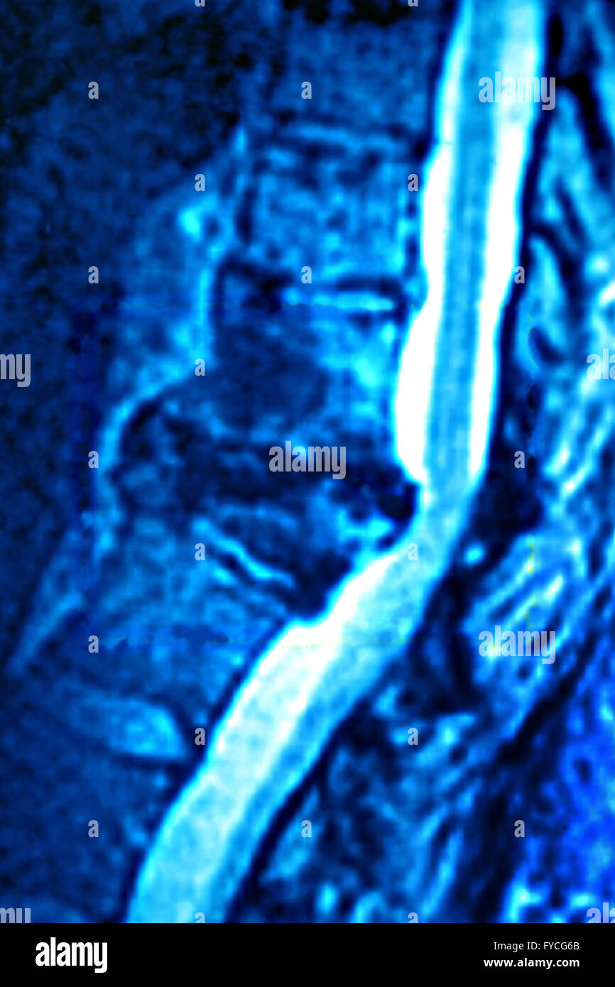 BANDSCHEIBENVORFALL, MRT Stockfoto