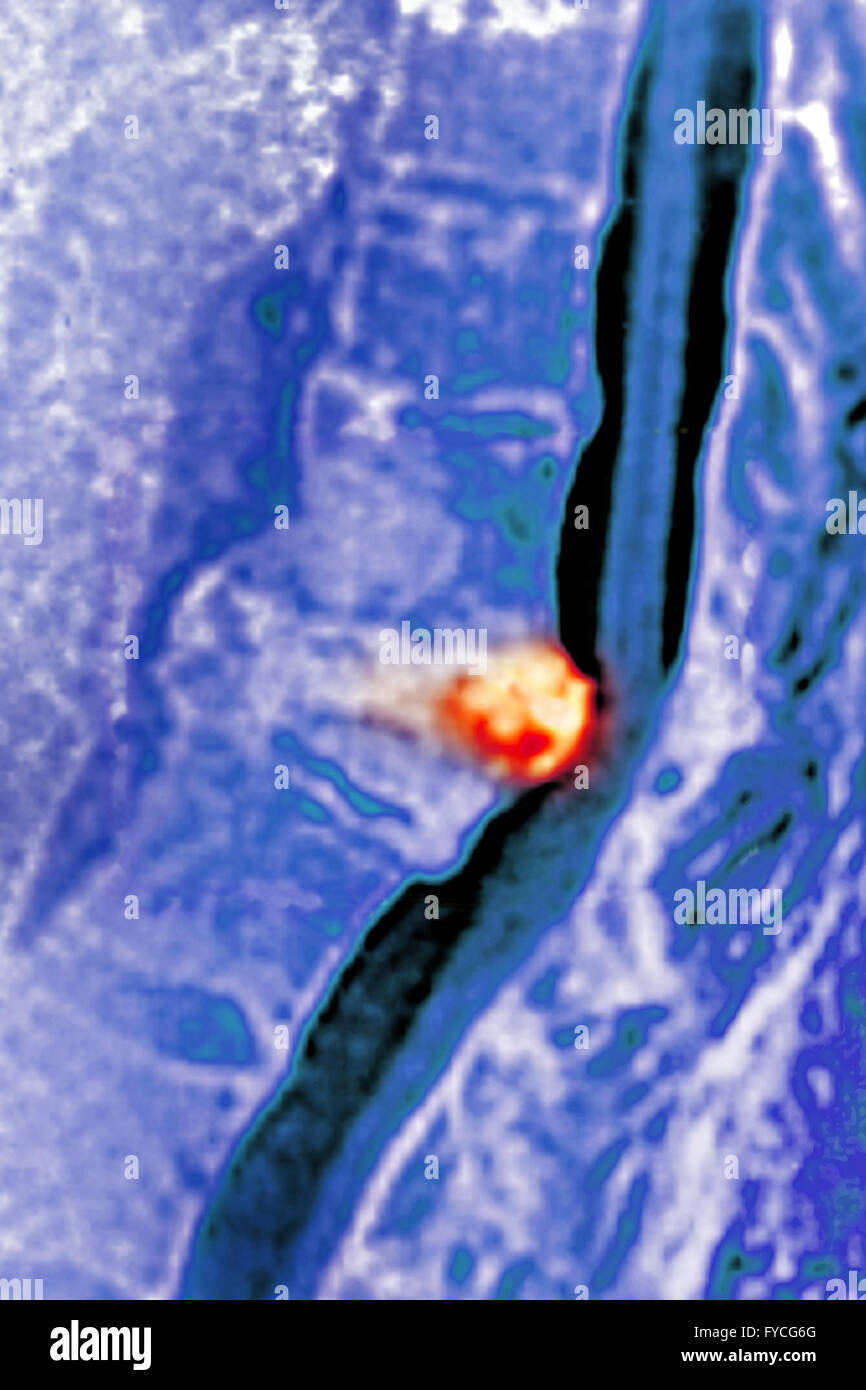 BANDSCHEIBENVORFALL, MRT Stockfoto