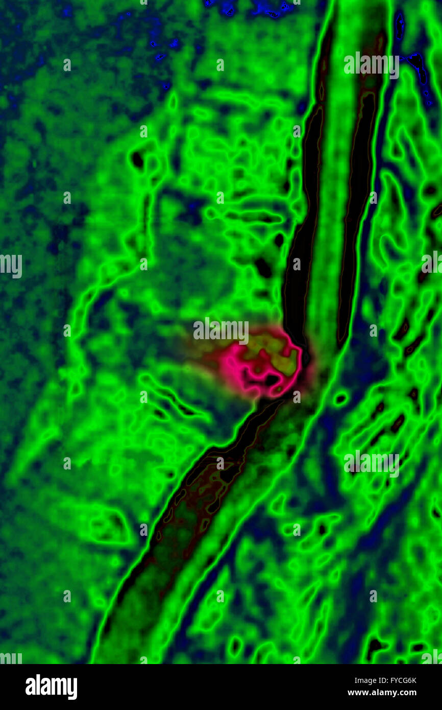 BANDSCHEIBENVORFALL, MRT Stockfoto