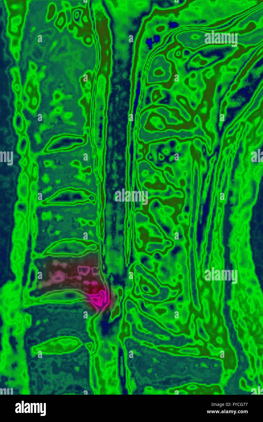 BANDSCHEIBENVORFALL, MRT Stockfoto