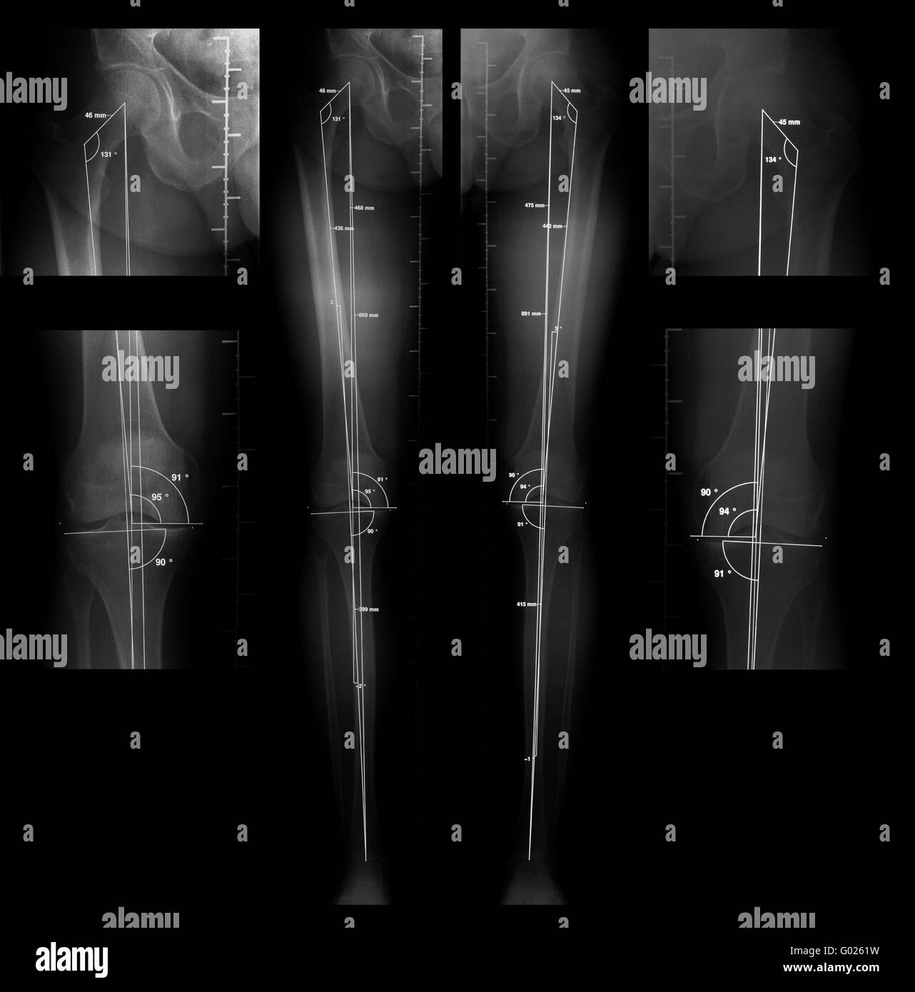X-ray für Länge und gemeinsame Ausrichtung Messung o Stockfoto