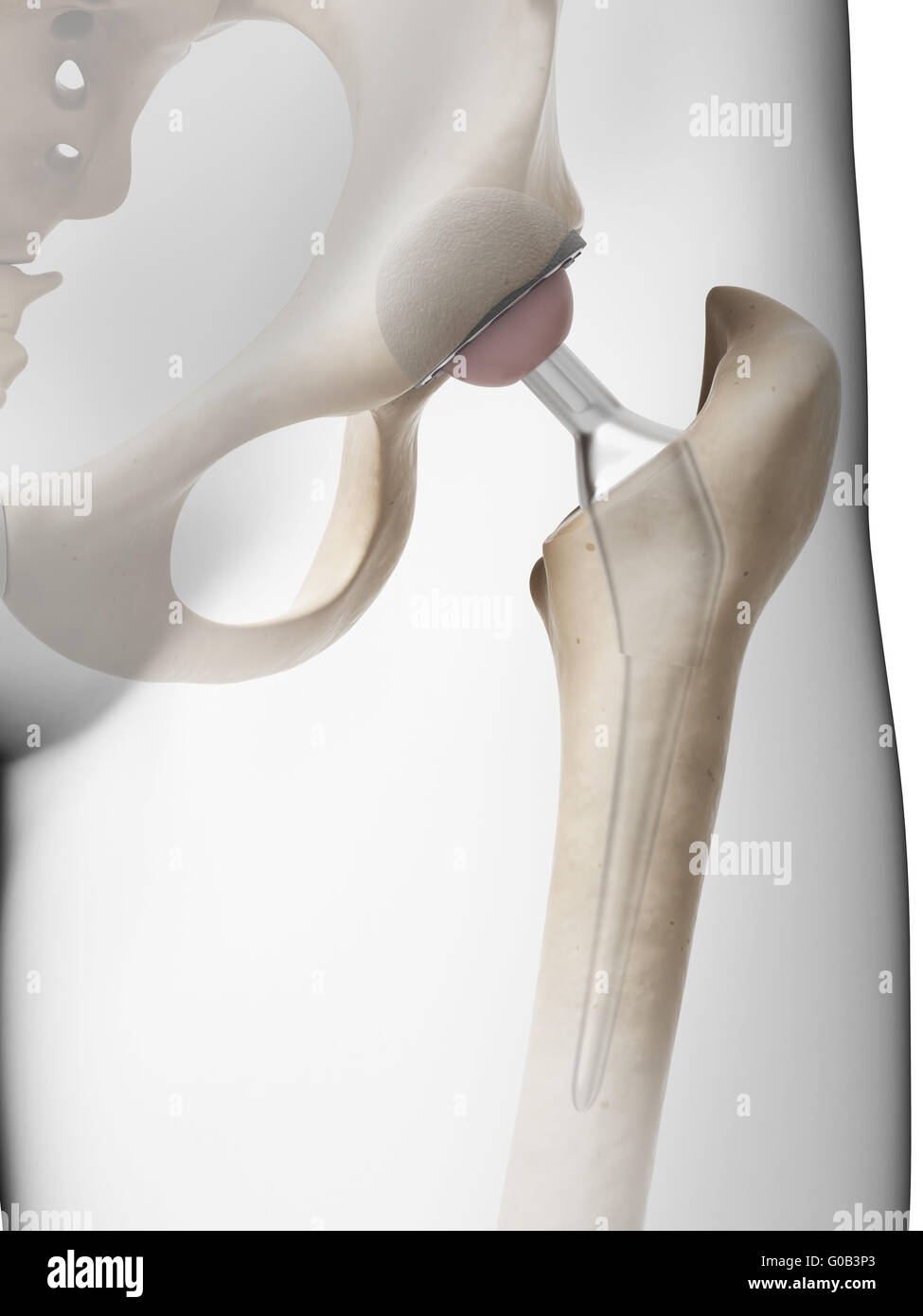 3D gerenderte Darstellung der ein künstliches Hüftgelenk Stockfoto
