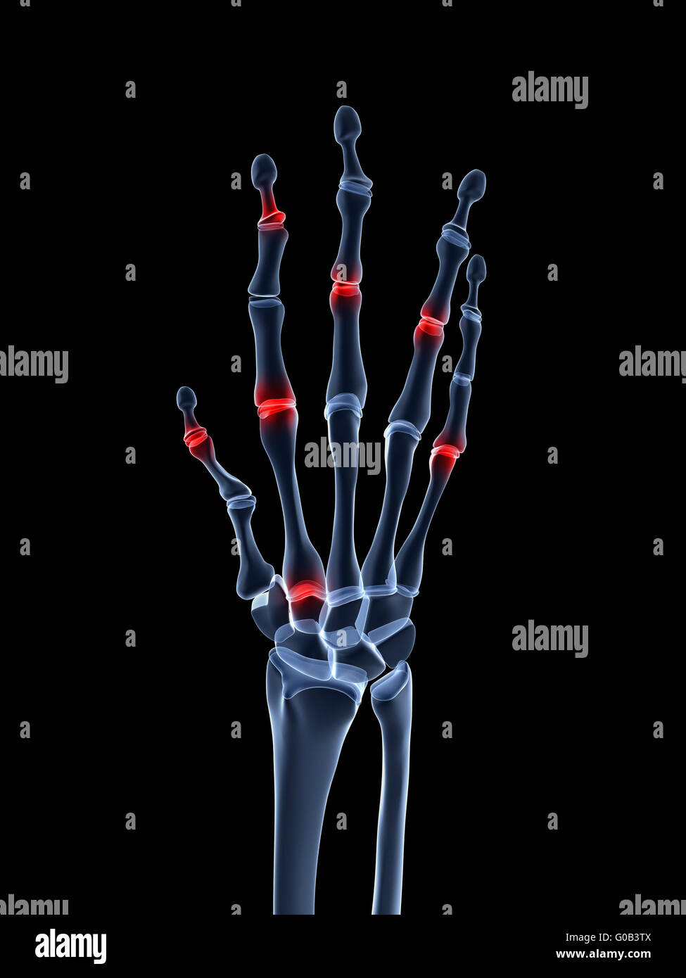 3D gerenderte Darstellung einer arthritischen Hand Stockfoto