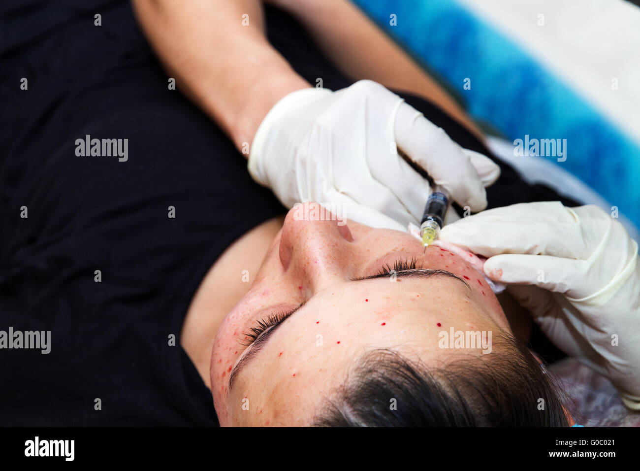 Injektionen im Gesicht mit kosmetischen Verfahren. Stockfoto