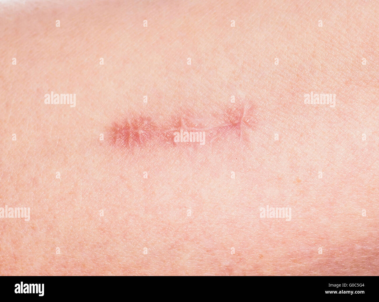 Plötzlich Stiche Auf Der Haut www.alamy.de