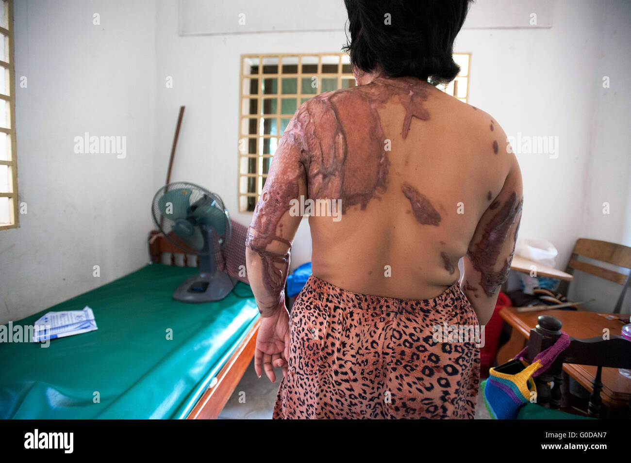 Sauren Gewalt Überlebenden im kambodschanischen Säure Überlebenden Charity (CASC) in Phnom Penh, Kambodscha. Stockfoto