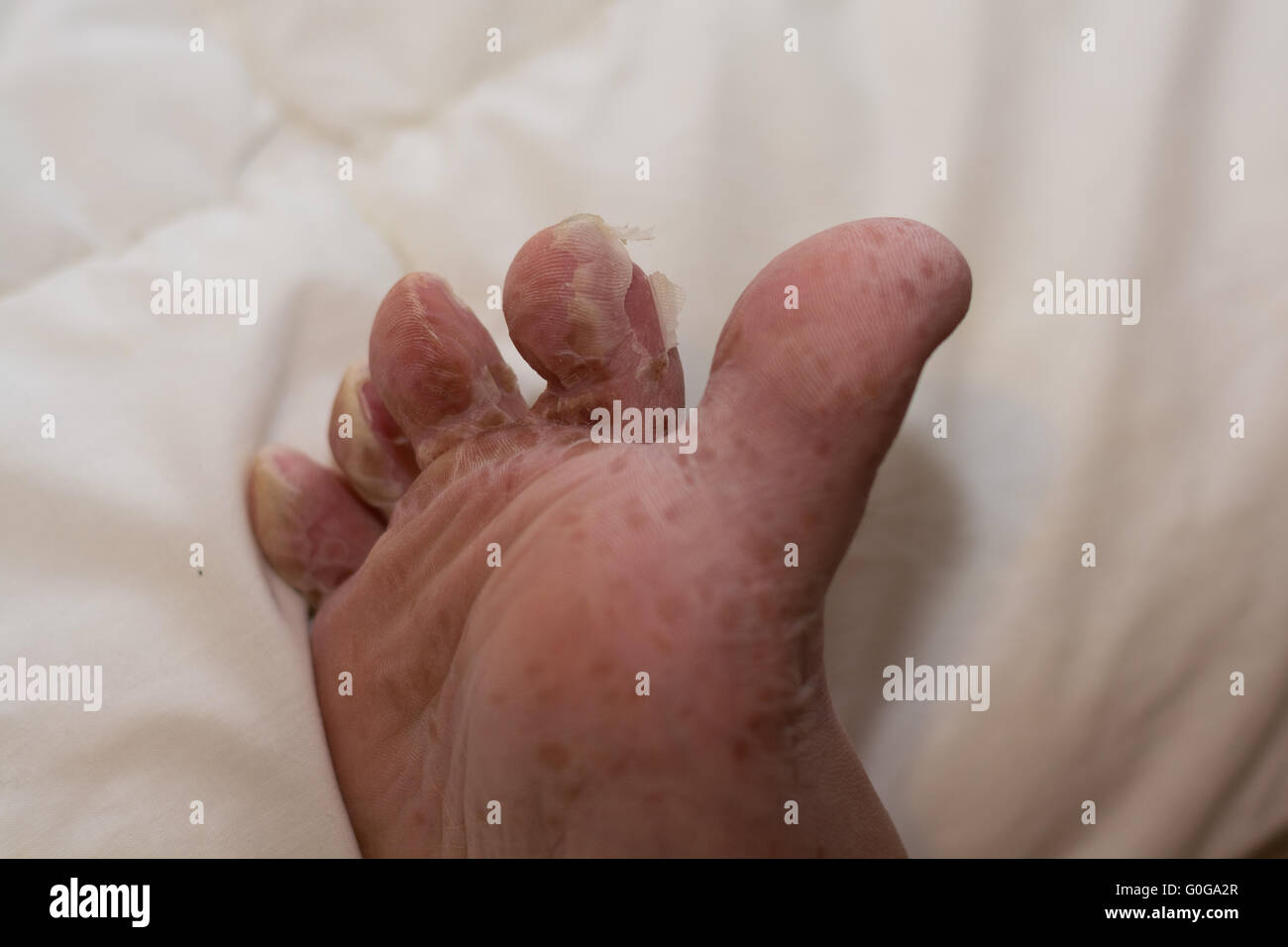 Schälen der Haut nach viralen Hautkrankheit - Closeup Fuß Stockfotografie -  Alamy