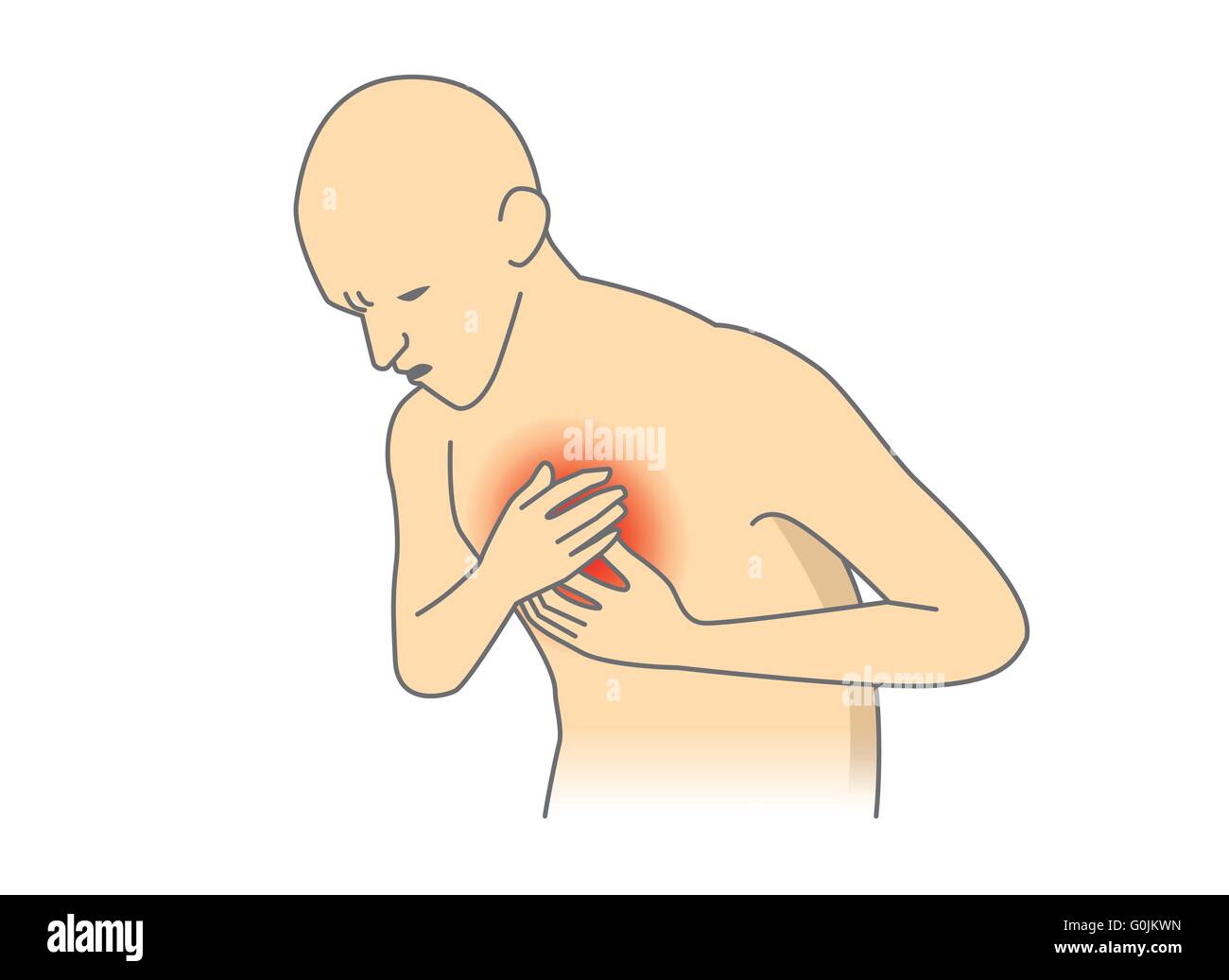 Menschen haben Symptome eines Herzinfarkts. Stock Vektor