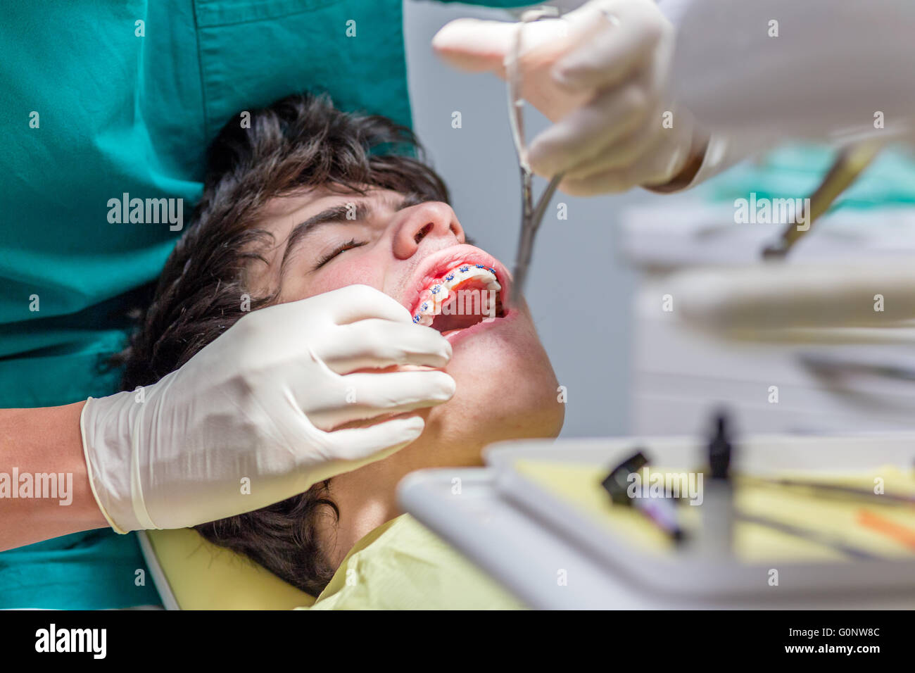 mit offenem Mund junge liegend auf dem Zahnarztstuhl während der Kieferorthopäde die Klammern an den Zähnen arrangieren Stockfoto