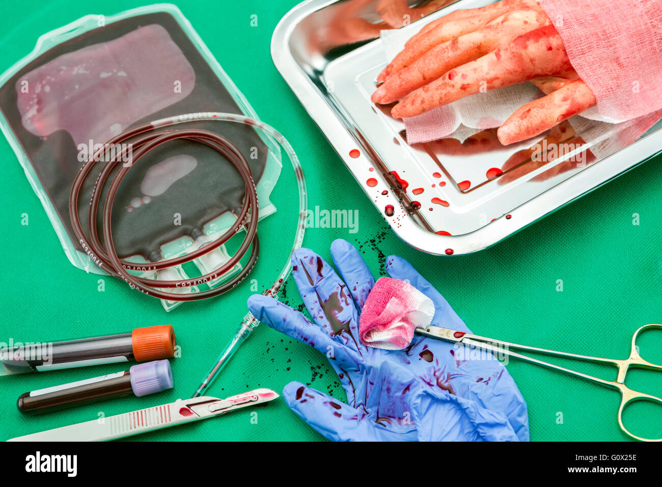 Einheit der Konzentration der roten Blutkörperchen, blutstillende Kocher Pinzette, Transplantation des oberen Extremität in einem OP-Raum Stockfoto