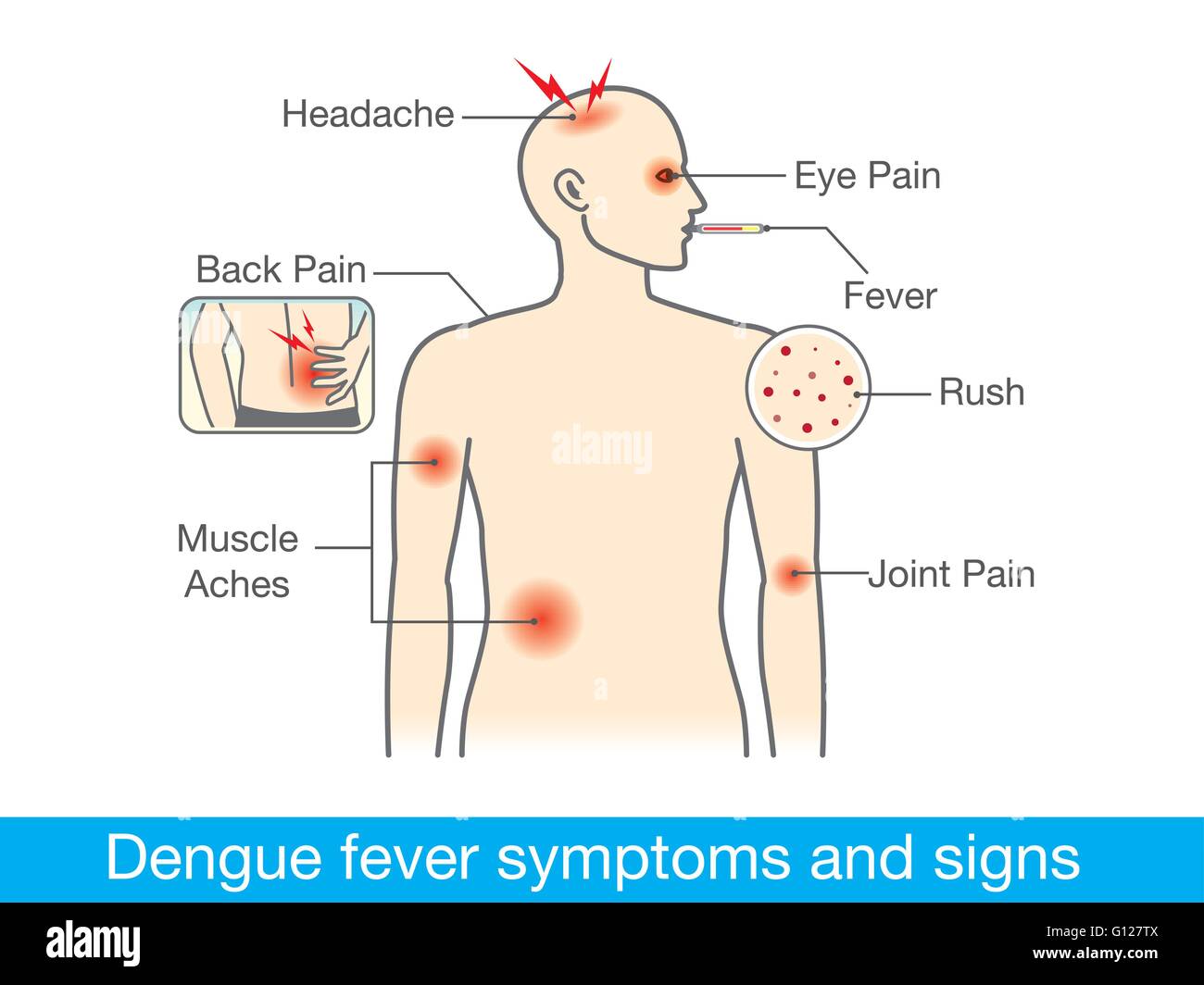 Dengue-Fieber-Symptome und Anzeichen Stock Vektor