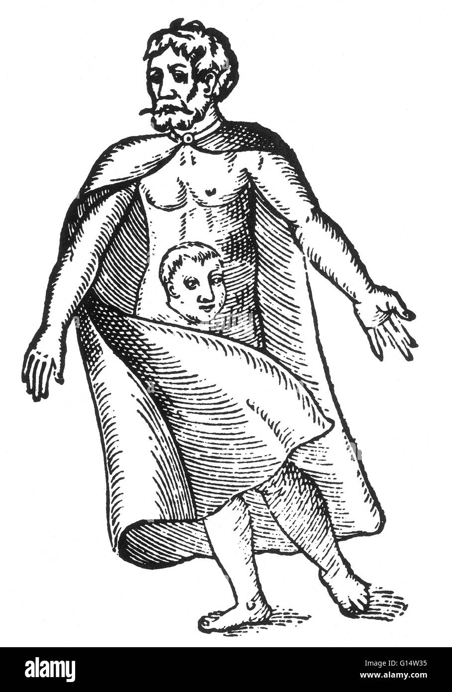 Holzschnitt von einem "Mann haben einen Kopf in der Mitte seines Körpers" von Des Monstres et Prodiges von Ambroise Paré, 1573. Ein parasitärer Zwilling (auch bekannt als ein asymmetrischer oder ungleiche siamesischen Zwilling) ist das Ergebnis der Prozesse, die verschwundenen Zwillinge und Con produzieren Stockfoto