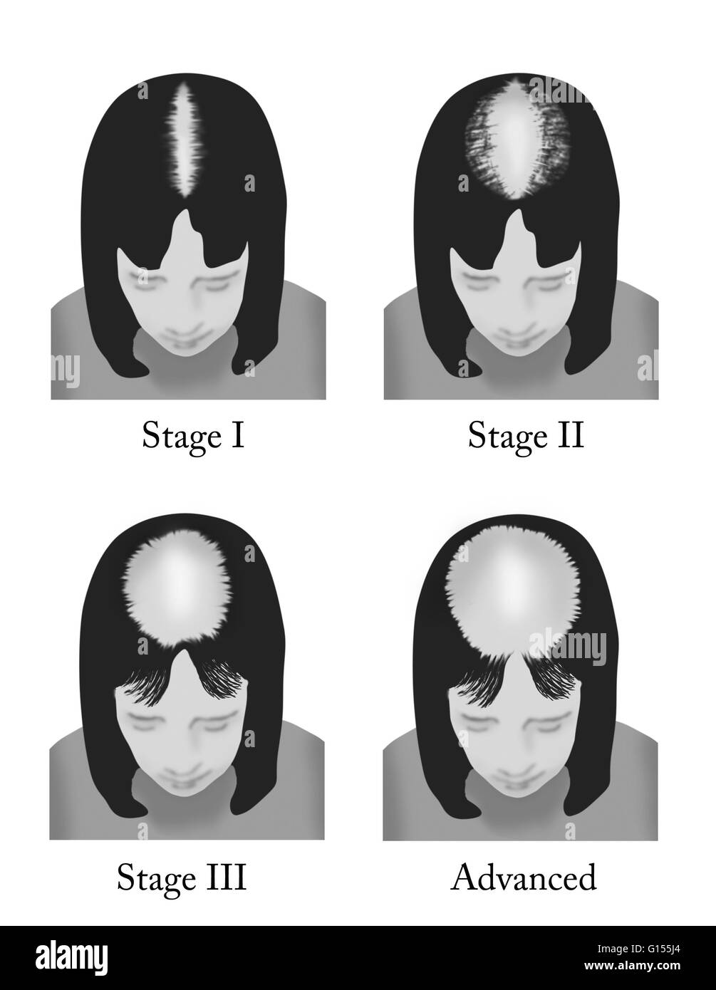 Progressive Stadien des Haarausfalls bei Frauen anhand der Ludwig Scale. Stockfoto