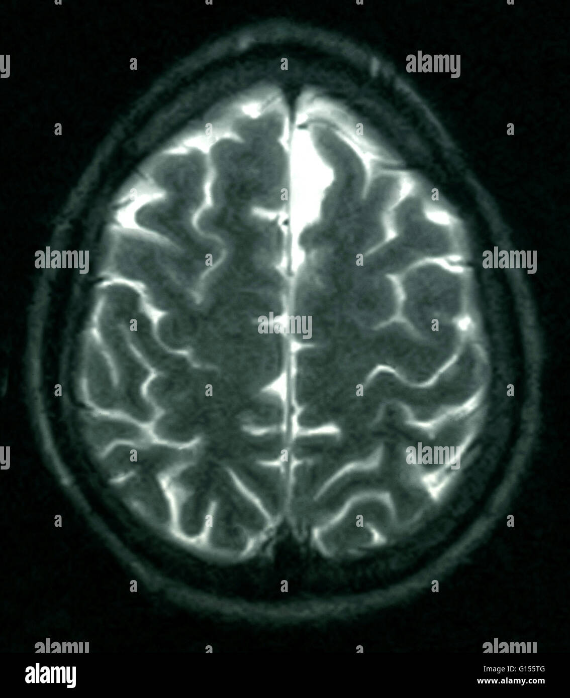 MRT des Gehirns (axiale Ansicht) ein 26 Jahre alter Mann. Das MRI erfolgte durch Kopfverletzungen bei einem Autounfall. Diagnose von des MRIS ist eine kleine Arachnoidalzyste im vorderen linken frontalen Region parasagittalen. Alle anderen Aspekte erscheinen normal. Stockfoto