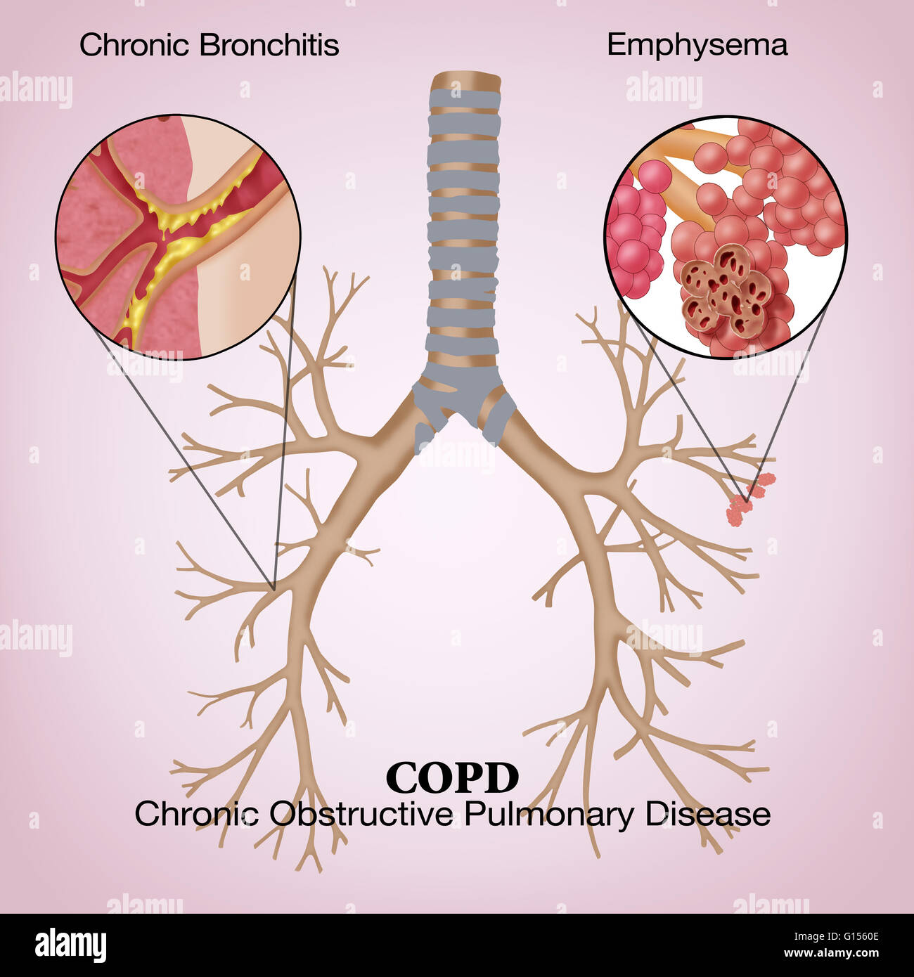 Illustration von chronisch obstruktiver Lungenerkrankung (COPD), einer  gemeinsamen Lungenerkrankung, wo die Atmung schwierig ist. Es gibt zwei  Hauptformen von COPD: chronische Bronchitis, deren Symptome einen  langfristige Husten mit Schleim sind ...