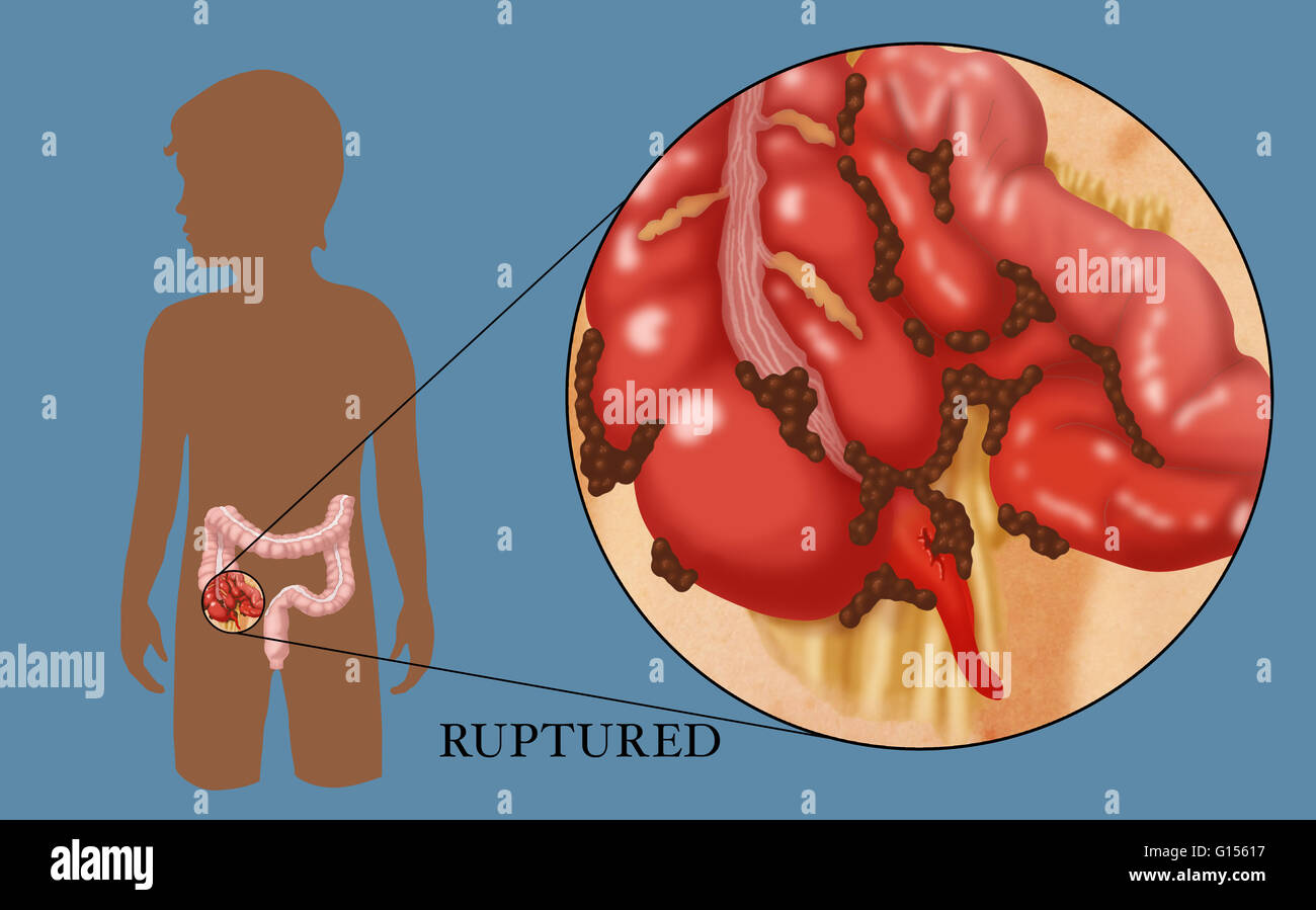 Eine Abbildung von einem Blinddarmdurchbruch durch unbehandelte Blinddarmentzündung verursacht. Die braunen Teilchen auf Blinddarmdurchbruch stellt entkam Fäkalien aus dem Dickdarm. Stockfoto