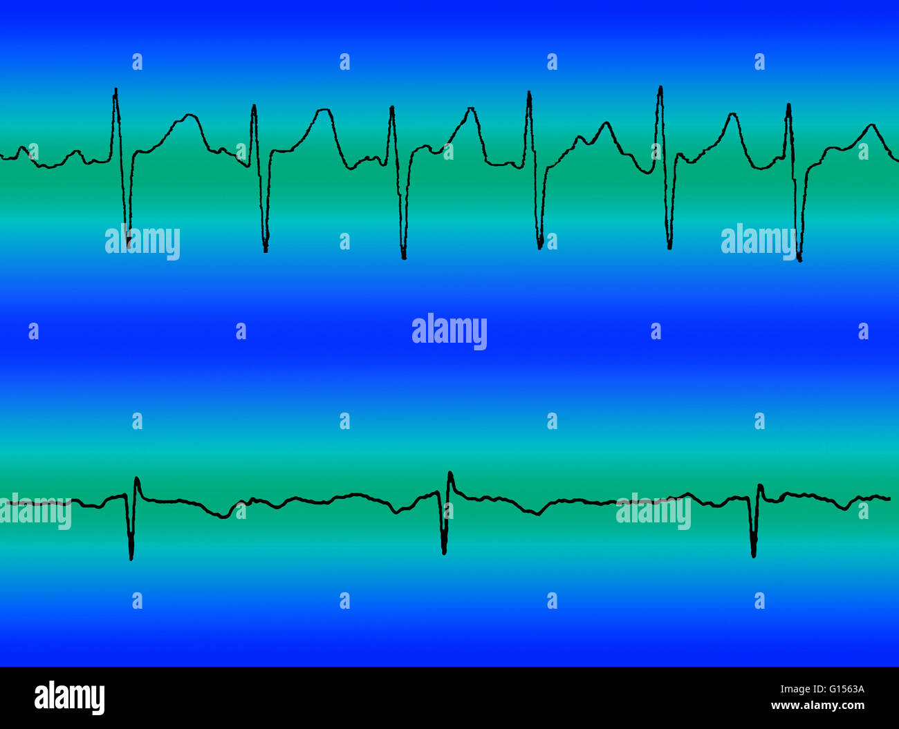 Zusammengesetztes Bild Vergleich ein Elektrokardiogramm (EKG) Auslesen von Vorhofflimmern (oben) und ein normales Herz schlagen (unten). Stockfoto