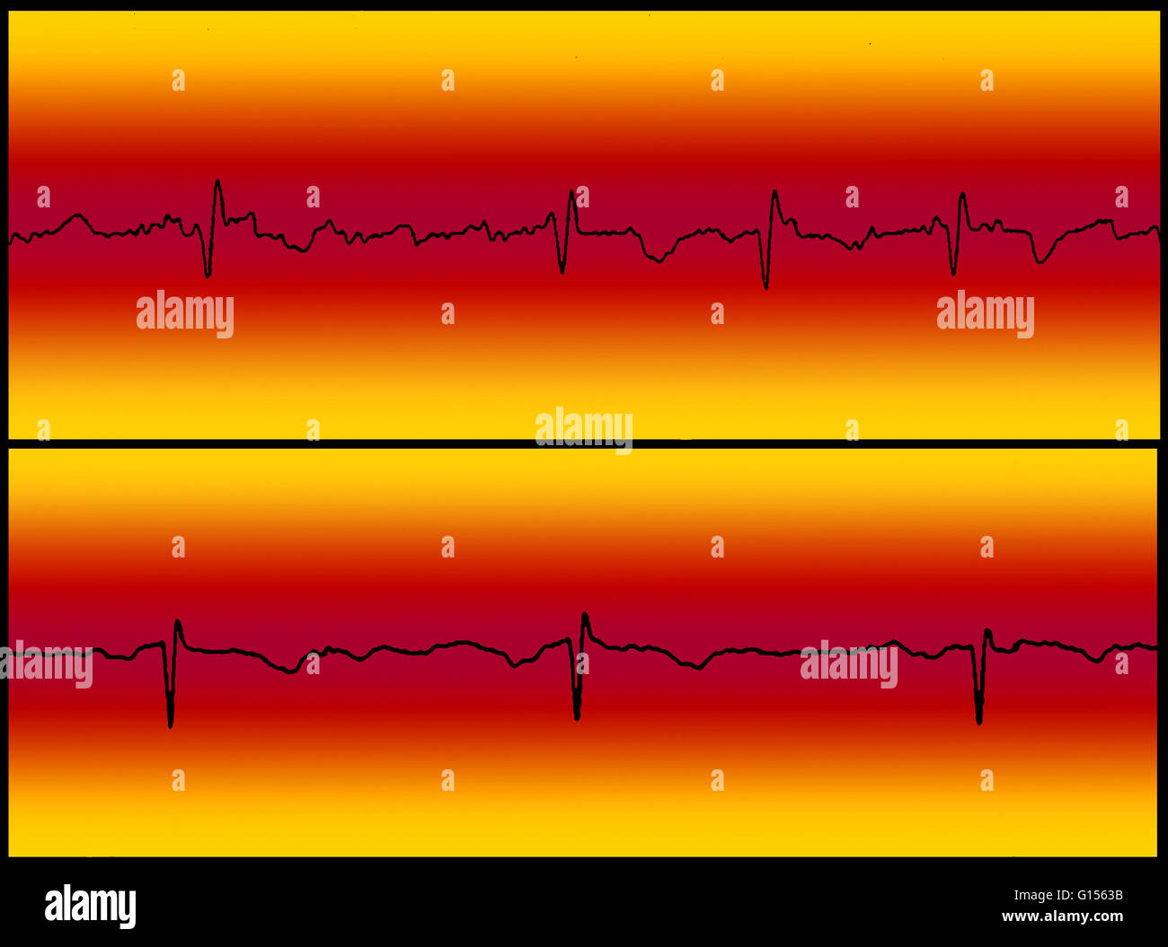Zusammengesetztes Bild Vergleich ein Elektrokardiogramm (EKG) Auslesen von Vorhofflimmern Flutter (oben) und ein normales Herz schlagen (unten). Stockfoto