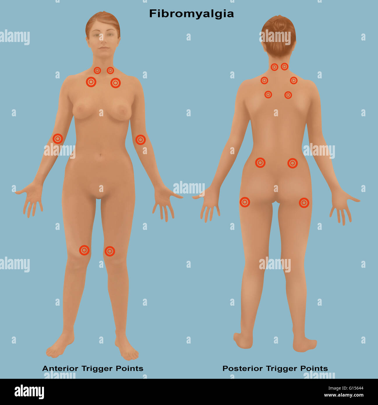 Darstellung der wichtigsten Bereiche im Körper, die Fibromyalgie zugeordnet sind, ein Muskel-Skelett-Schmerzen eine Müdigkeit Störung, bei denen die Ursache noch unbekannt ist. Die Fibromyalgie ist Schmerz in den Muskeln, Sehnen, Bänder und weichen Bindegewebe des Körpers Stockfoto