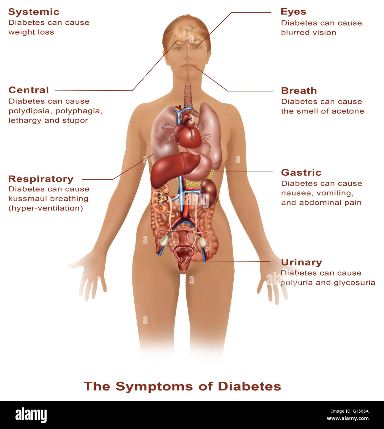 Darstellung der Frau, die die Symptome des Diabetes. Stockfoto