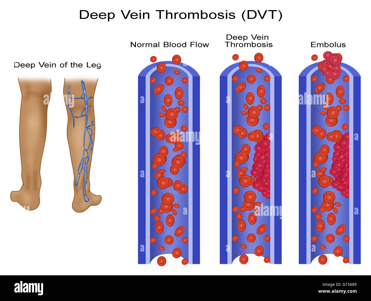 Infografik Mit Tiefer Venenthrombose Ausgeschnittene Stockfotos und