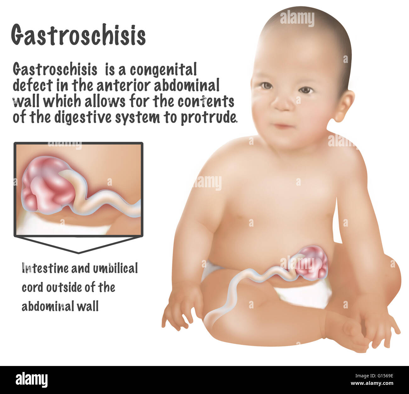 Eine Abbildung eines Babys mit Gastroschisis. Gastroschisis ist ein angeborener Defekt in der vorderen Bauchwand, wodurch für den Inhalt des Verdauungssystems herausragen. 1 Baby in 30 ist mit einem oder mehreren großen Missbildungen geboren. Die meisten sind Korrekturen Stockfoto