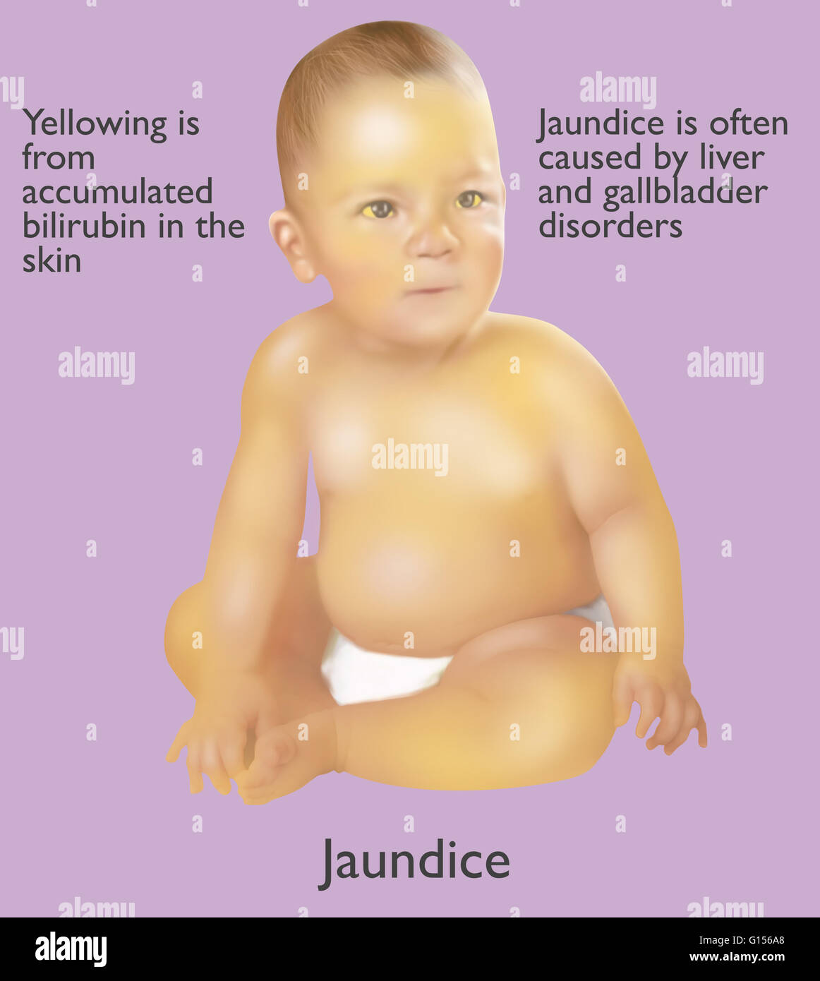Abbildung eines Säuglings mit Gelbsucht. Gelbsucht wird oft durch Leber und Gallenblase Erkrankungen verursacht. Die gelbe Farbe stammt aus angesammelten Bilirubin in der Haut. Stockfoto