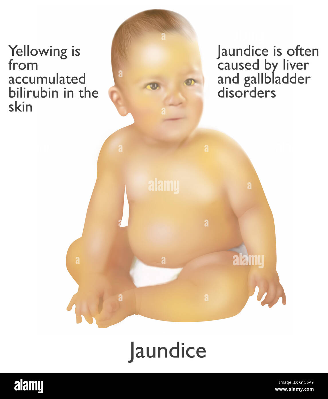 Abbildung eines Säuglings mit Gelbsucht. Gelbsucht wird oft durch Leber und Gallenblase Erkrankungen verursacht. Die gelbe Farbe stammt aus angesammelten Bilirubin in der Haut. Stockfoto