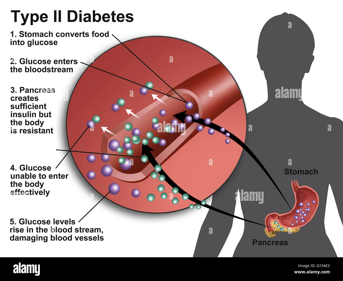 Llustration von Insulin und GlukoseProduktion bei Typ2 Diabetes. Insulin wird von Inselzellen Llustration von Insulin und GlukoseProduktion bei Typ2 Diabetes. Insulin wird von Inselzellen