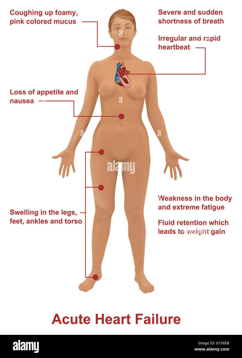 Llustration zeigt Symptome einer akuten Herzinsuffizienz bei einer Frau