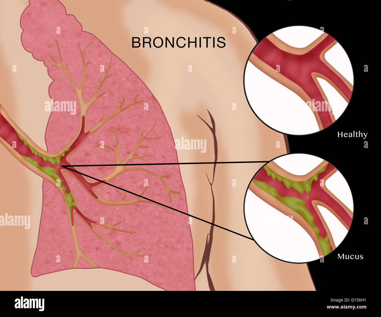 Abbildung mit Bronchitis, eine Krankheit, in denen die Schleimhäute der  Bronchien (Atemwege in die Lunge) entzündet und mit Schleim verstopft  werden. Es gibt zwei Arten: akute und chronische. Ersteres ist in der