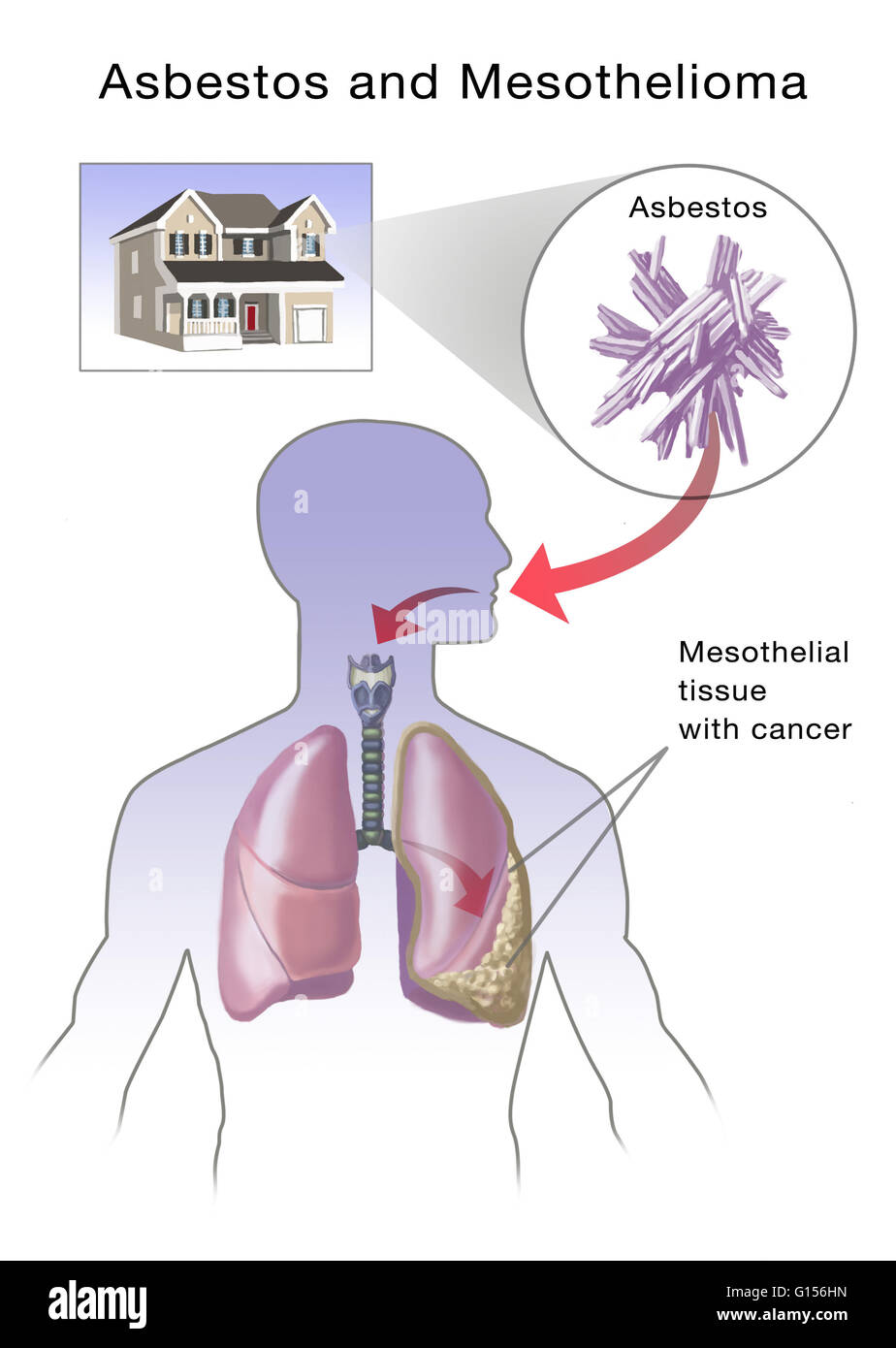mesothelioma vs carcinoma