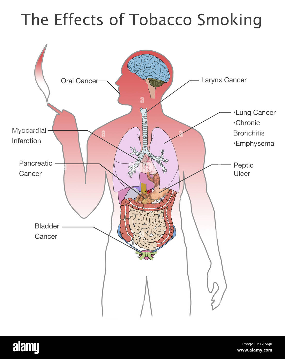 Abbildung zeigt die breite Palette von gesundheitlichen Beeinträchtigungen, die Rauchtabak verursachen können und ihre Standorte in den menschlichen Körper, einschließlich (im Uhrzeigersinn von oben links): Mundkrebs, Kehlkopfkrebs, Lungenkrebs, chronische Bronchitis, Emphysem, Verdauungs-Ulce Stockfoto