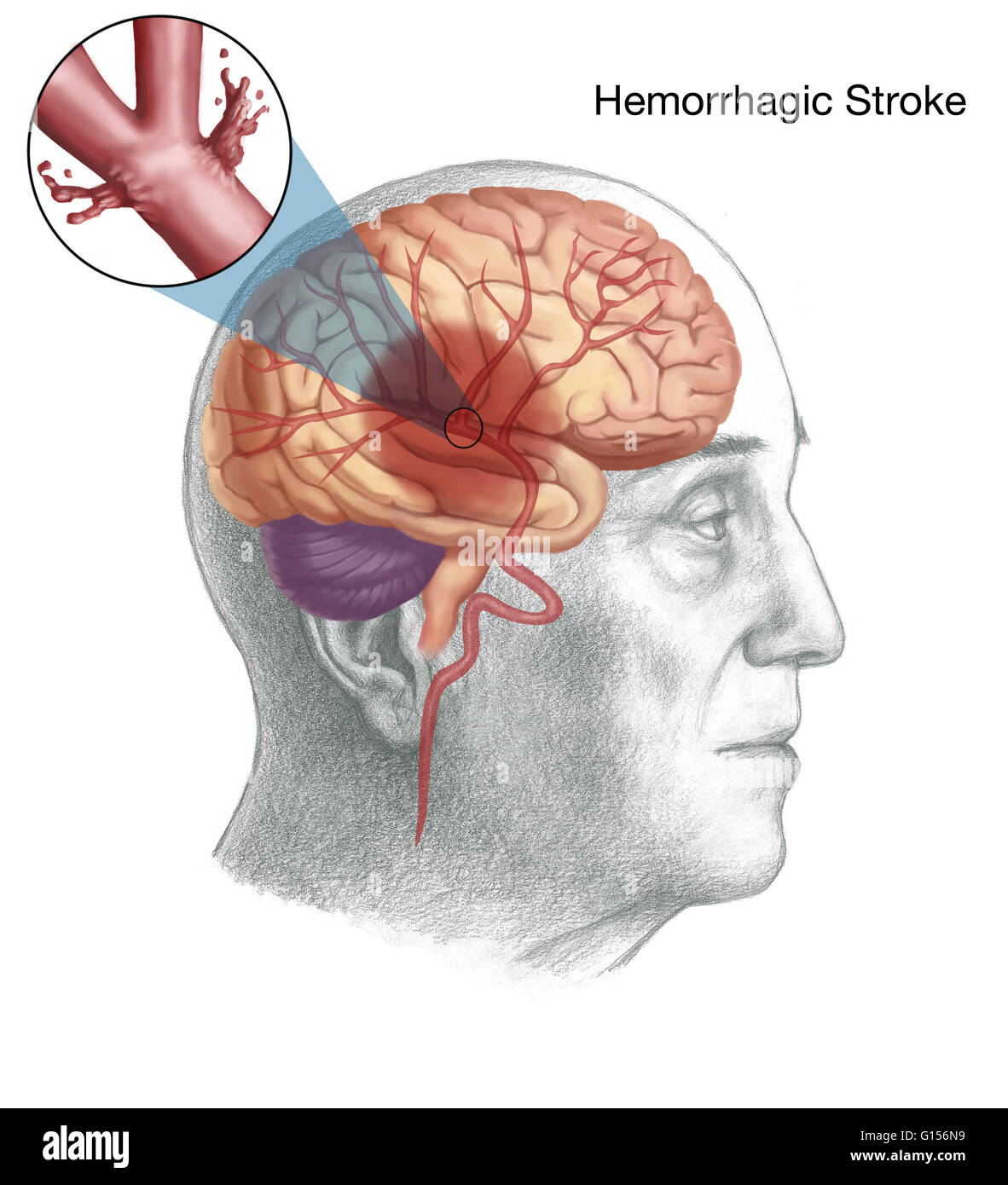 Darstellung des Mechanismus der ein hämorrhagischer Schlaganfall, speziell eine Intra-axiale Blutung (Blut innerhalb des Gehirns). Stockfoto