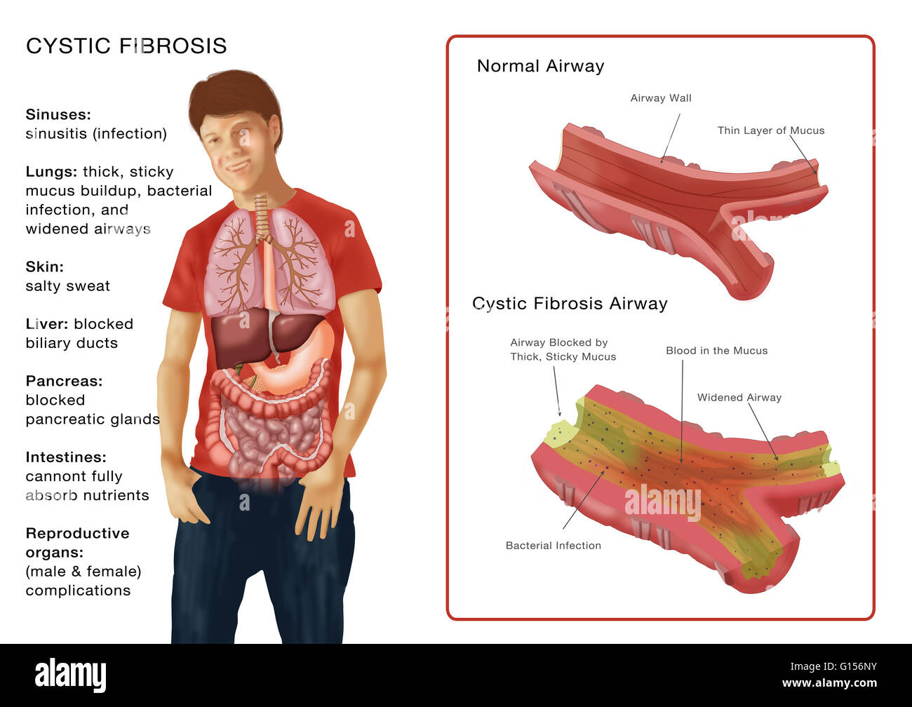 Abbildung Inserat Symptome der zystische Fibroses (CF), und eine normale Bronchialsystem (oben), eine verstopfte Bronchien (unten) zu vergleichen. Die bronchiale unten durch einen dicken, klebrigen und blutigen Schleim blockiert ist, hat eine bakterielle Infektion (kleine schwarze Punkte), und Stockfoto
