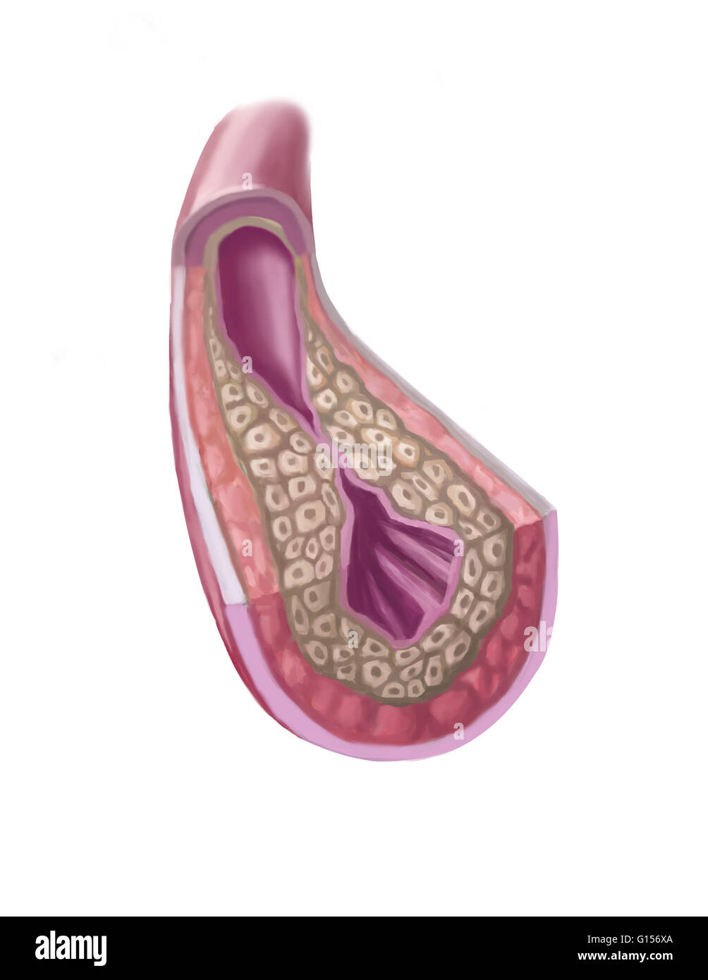 Eine verstopfte Arterie oder Atherosklerose (arteriosklerotischer Gefäßerkrankungen - ASVD) ist, wenn die Arterienwände durch den Aufbau von Cholesterin verdicken. Die Anhäufung von mehreren Plaques kann zu Schlaganfällen und Herzstillstand oft ohne vorherige Symptome führen. Stockfoto