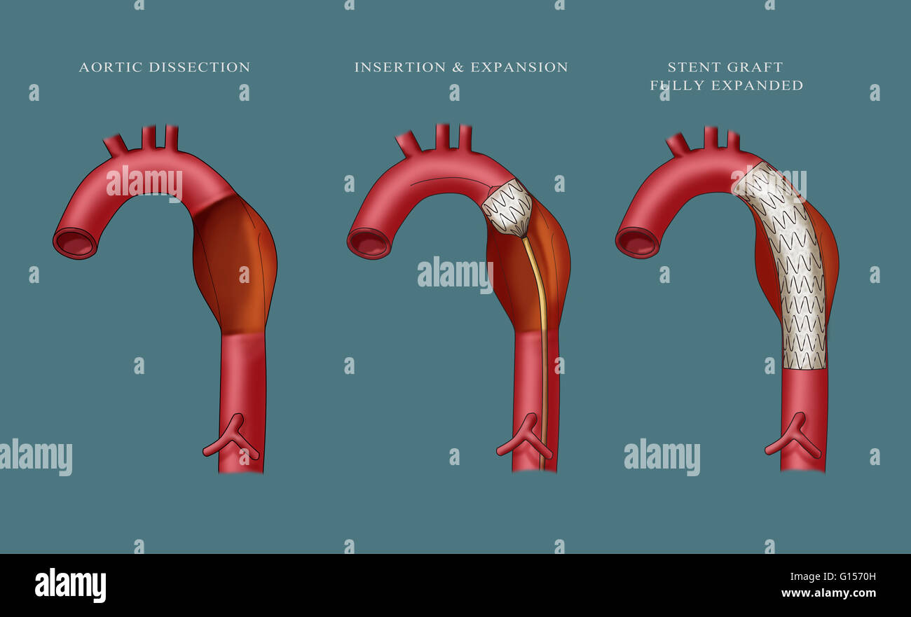 Abbildung einfügen von einem Aortenaneurysma Stent darstellt. Ganz links zeigt Aortendissektion ...