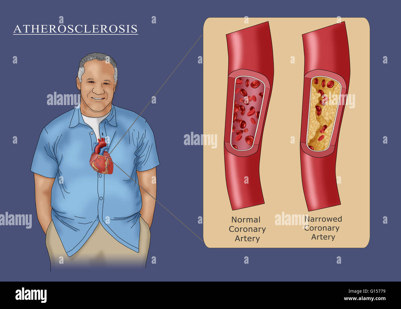Abbildung zeigt einen Mann mit Atherosklerose, die Begrenzung der Blutfluss durch die Arterie durch Plaque-Blockade (Einschub rechts). Zum Vergleich ist auch eine normale Arterie im Einschub (links) angezeigt. Stockfoto