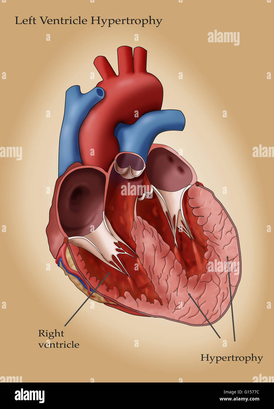 Abbildung des Herzens mit Hypertrophie des linken Ventrikels. Linken Ventrikels Hypertrophie (LHV) kann in Reaktion auf Faktoren wie Bluthochdruck entwickeln, die die linke Herzkammer, härter zu arbeiten erfordern. Die Arbeitsbelastung erhöht, die Wände des t Stockfoto