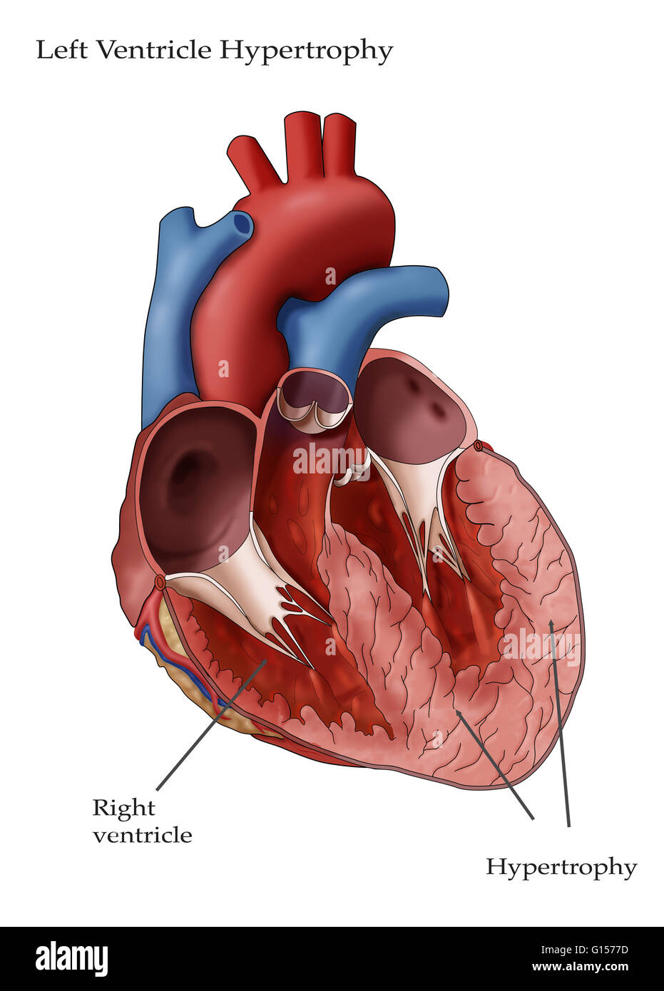 Abbildung des Herzens mit Hypertrophie des linken Ventrikels. Linken Ventrikels Hypertrophie (LHV) kann in Reaktion auf Faktoren wie Bluthochdruck entwickeln, die die linke Herzkammer, härter zu arbeiten erfordern. Die Arbeitsbelastung erhöht, die Wände des t Stockfoto