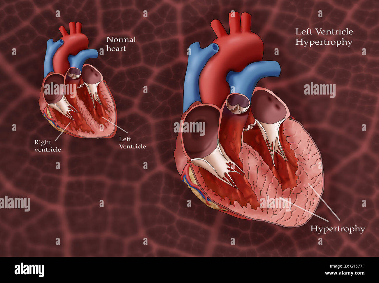 Abbildung zeigt ein normales Herz auf der linken Seite und ein Herz mit linken Ventrikels Hypertrophie auf der rechten Seite. Linken Ventrikels Hypertrophie (LHV) kann in Reaktion auf Faktoren wie Bluthochdruck entwickeln, die die linke Herzkammer, härter zu arbeiten erfordern. Als die workl Stockfoto