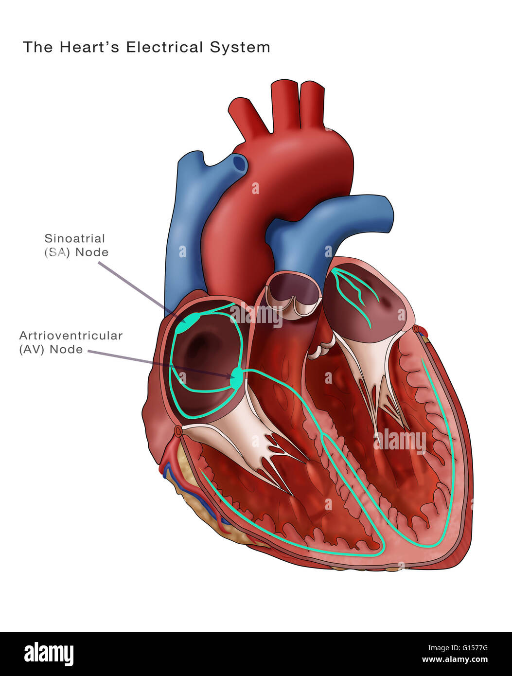 Abbildung zeigt das Herz Elektrik. Der Sinusknoten und Atrioventricular Knoten sind kommentiert. Der sinoatrial (SA)-Knoten (dicken grünen Oval oben links) besteht aus self-excitatory Muskelzellen, die rhythmisch auf rund 70 Vertrag Stockfoto