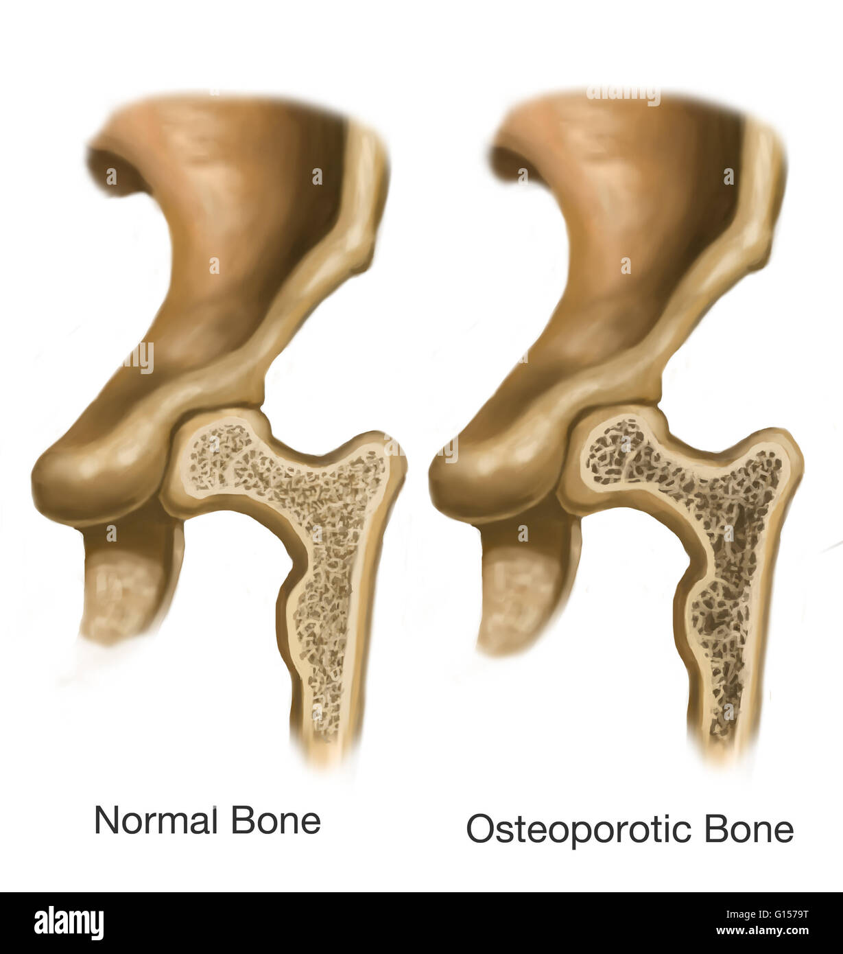 Darstellung einer osteoporotischen Knochen (rechts) im Vergleich zu einem normalen Knochen (auf der linken Seite). Der osteoporotische Knochen ist ein poröser (schwammig) Knochen fehlt es an Masse und Dichte. Die kompakte Knochen zeigt eine normale Masse und Dichte. Stockfoto