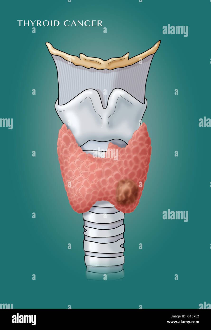 Beschriftete Abbildung des Kehlkopfes und der Schilddrüse, eine bösartige Wucherung (Schilddrüsenkrebs) zeigen. Stockfoto
