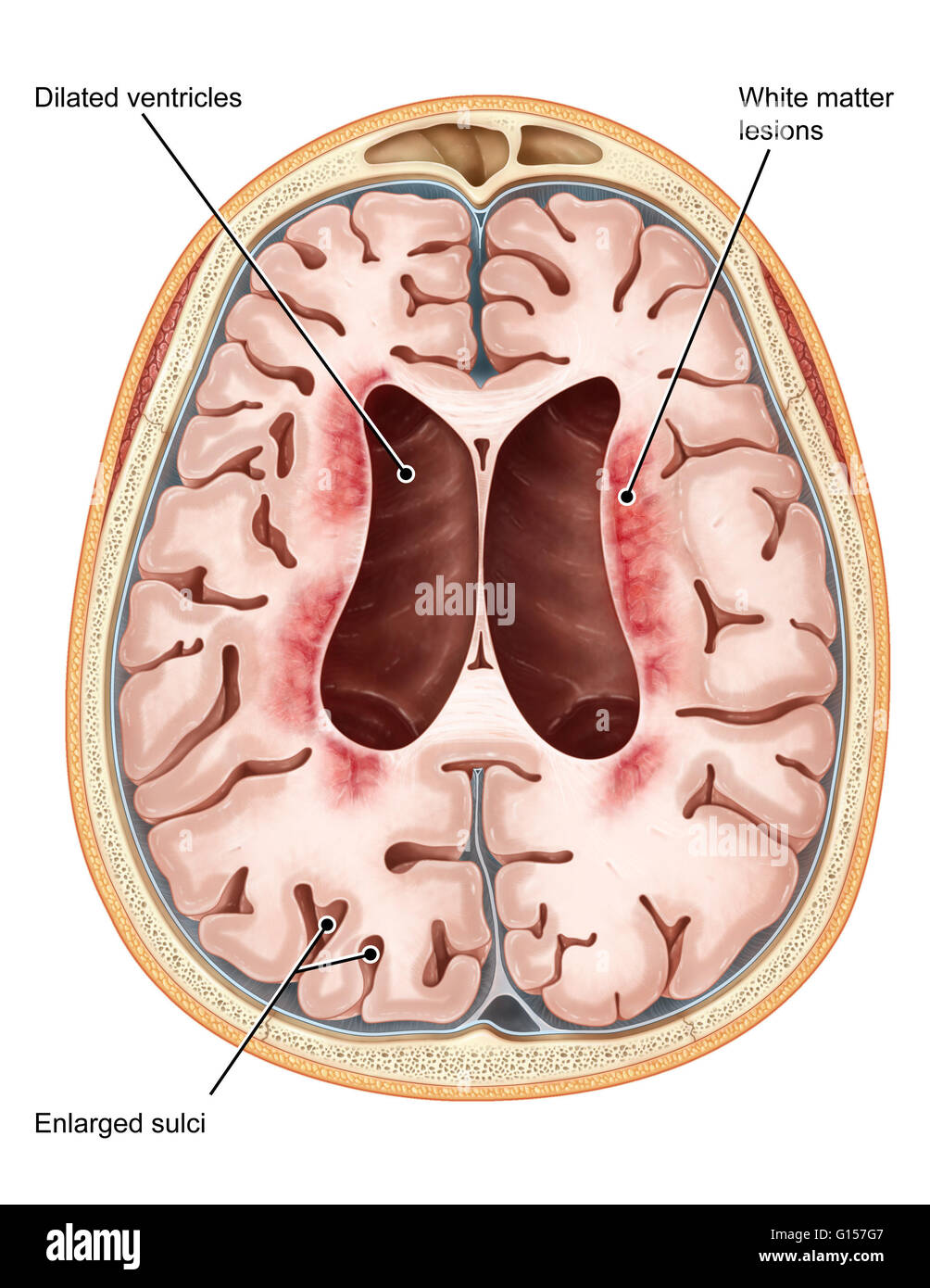 Eine illustrierte Querschnitt des Gehirns ein Patient leidet neuronale Ceroid Lipofuscinosis (NCL). Diese neurologische Erbkrankheit erscheint im Kleinkindalter und zeichnet sich aufgrund des Alters der Ausbruch der Krankheit. Genetische Mutationen verhindern Stockfoto